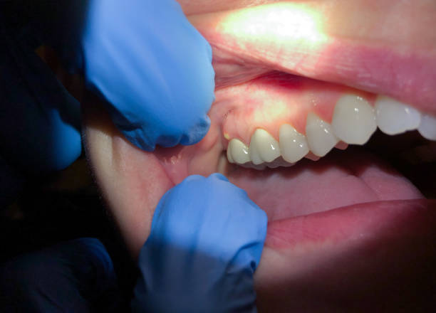 Best Emergency Dental Extractions in Dunkirk, MD